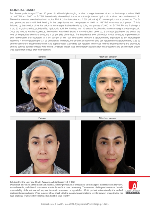 Combining Nd:YAG and Er:YAG Laser with Intradermal Hyaluronic Acid and Neurotoxin for Skin Tightening and Rejuvenation
