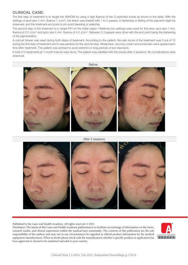 Treatment of ABNOM with PIH using Q-switched Nd:YAG Laser