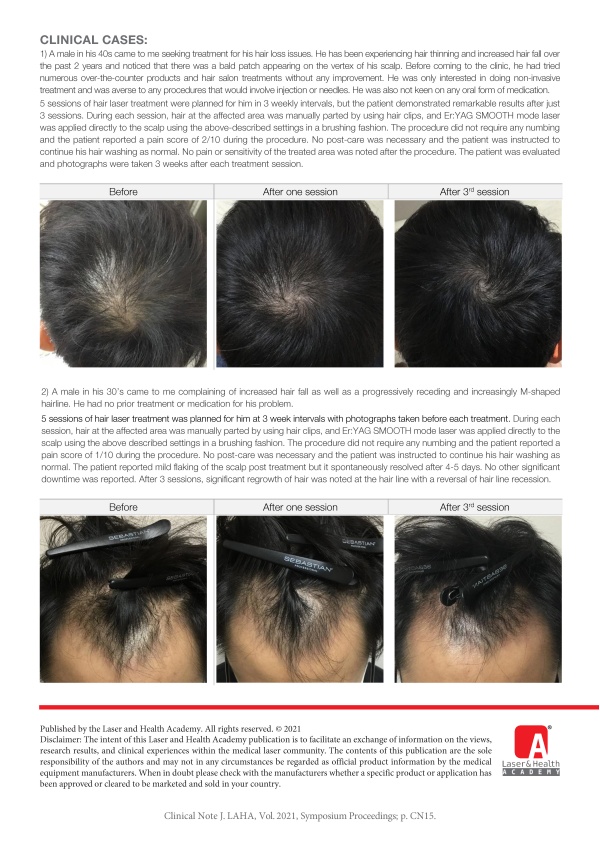 Treatment of Androgenetic Alopecia with Non-ablative Erbium:YAG Laser