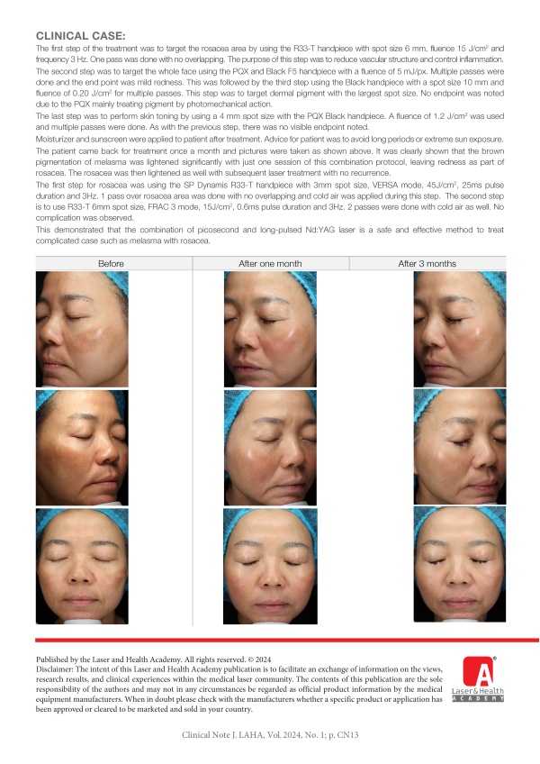 Rosacea and Melasma Treatment with Combination of Picosecond and Long-Pulsed Nd:YAG Laser